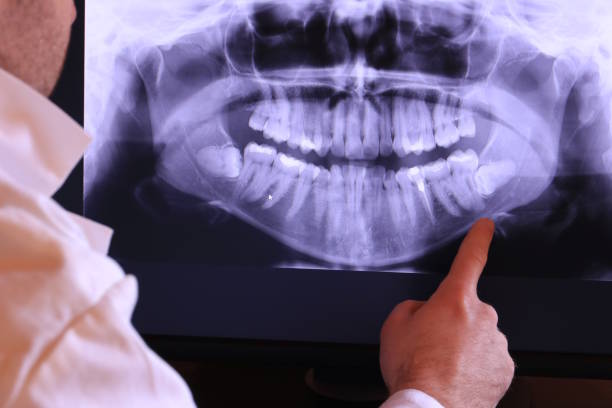 Best Emergency Wisdom Teeth Removal in Belcourt, ND